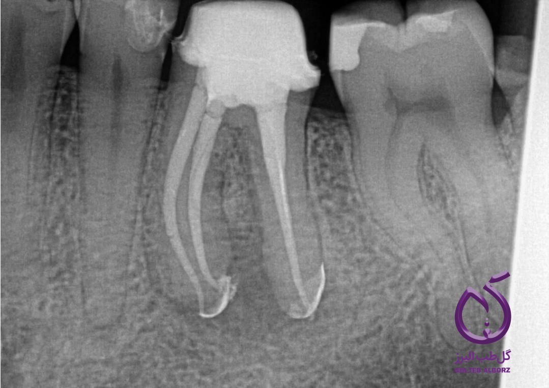 آبچوریشن سه بعدی روت کانال